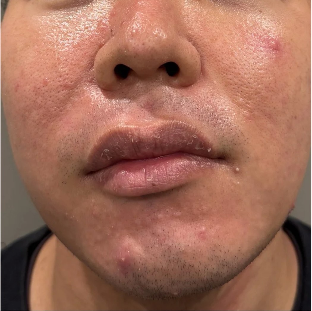 イソトレチノイン治療前 - 重症ニキビ（化膿性ニキビ・炎症性ニキビ）の状態