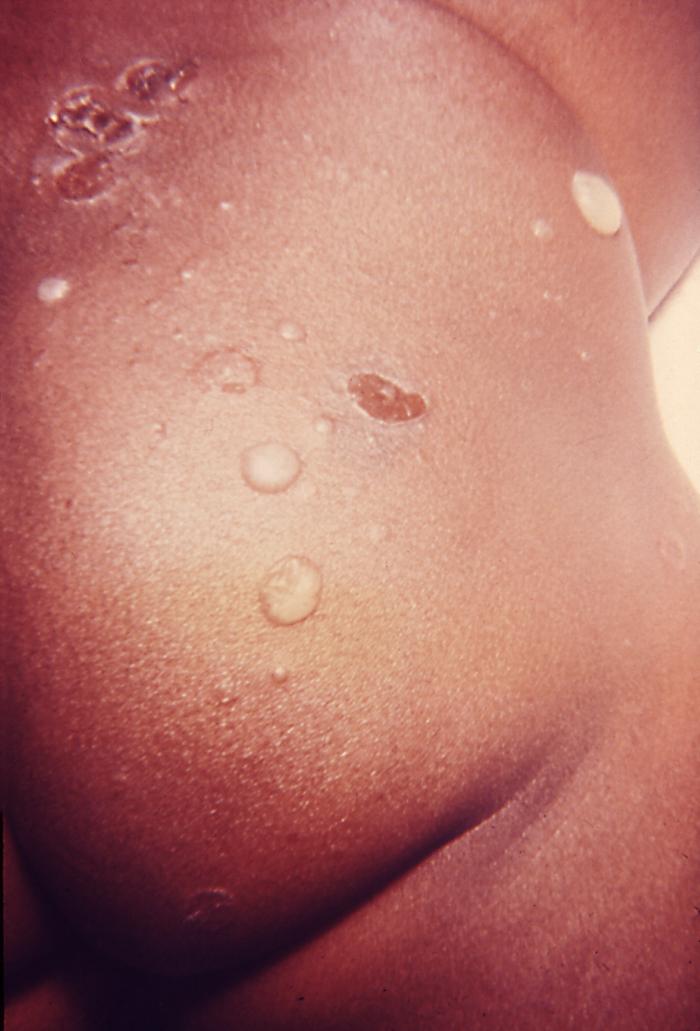 とびひ（伝染性膿痂疹）による水疱と痂皮を伴う皮膚病変