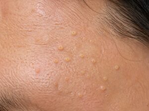 池袋の脂腺増殖症治療｜皮膚科医が原因・見分け方・治療を解説