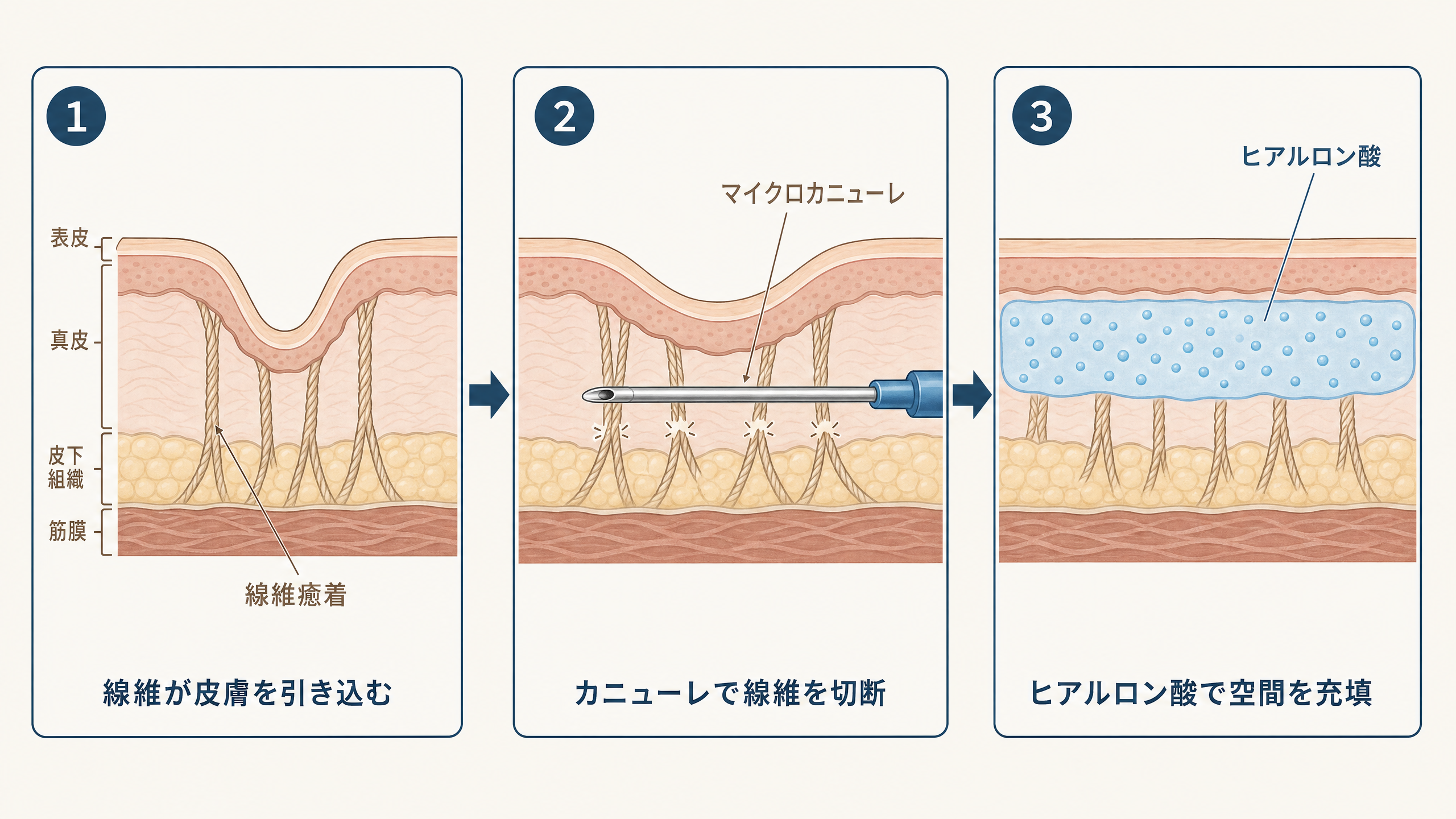 サブシジョン治療の仕組み｜線維癒着の切断とヒアルロン酸充填の3ステップ図解