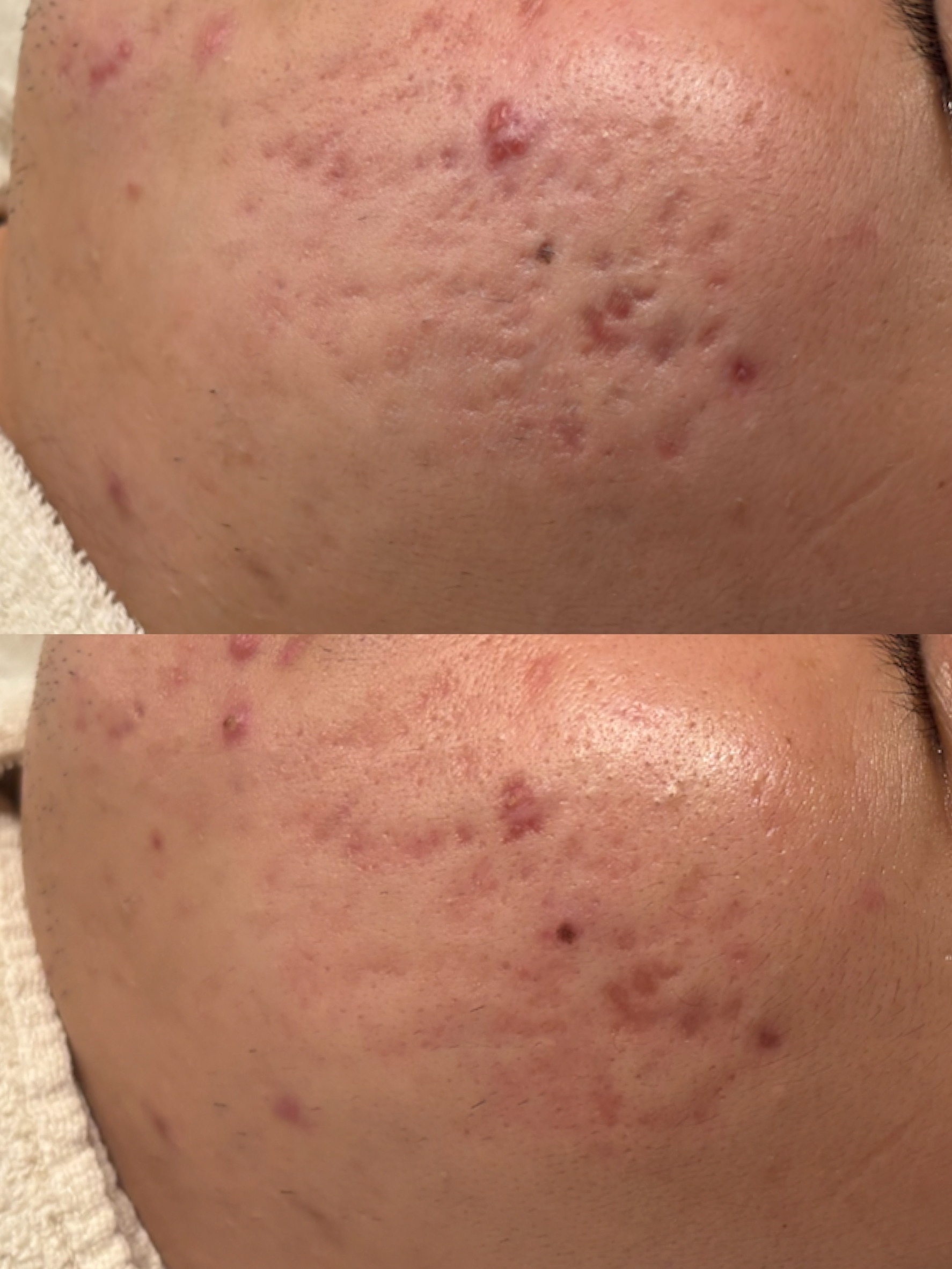 20代男性の左頬のキュアジェット1回施術前後の症例写真。基本薬剤はジュベルック。上がbefore、下がafter