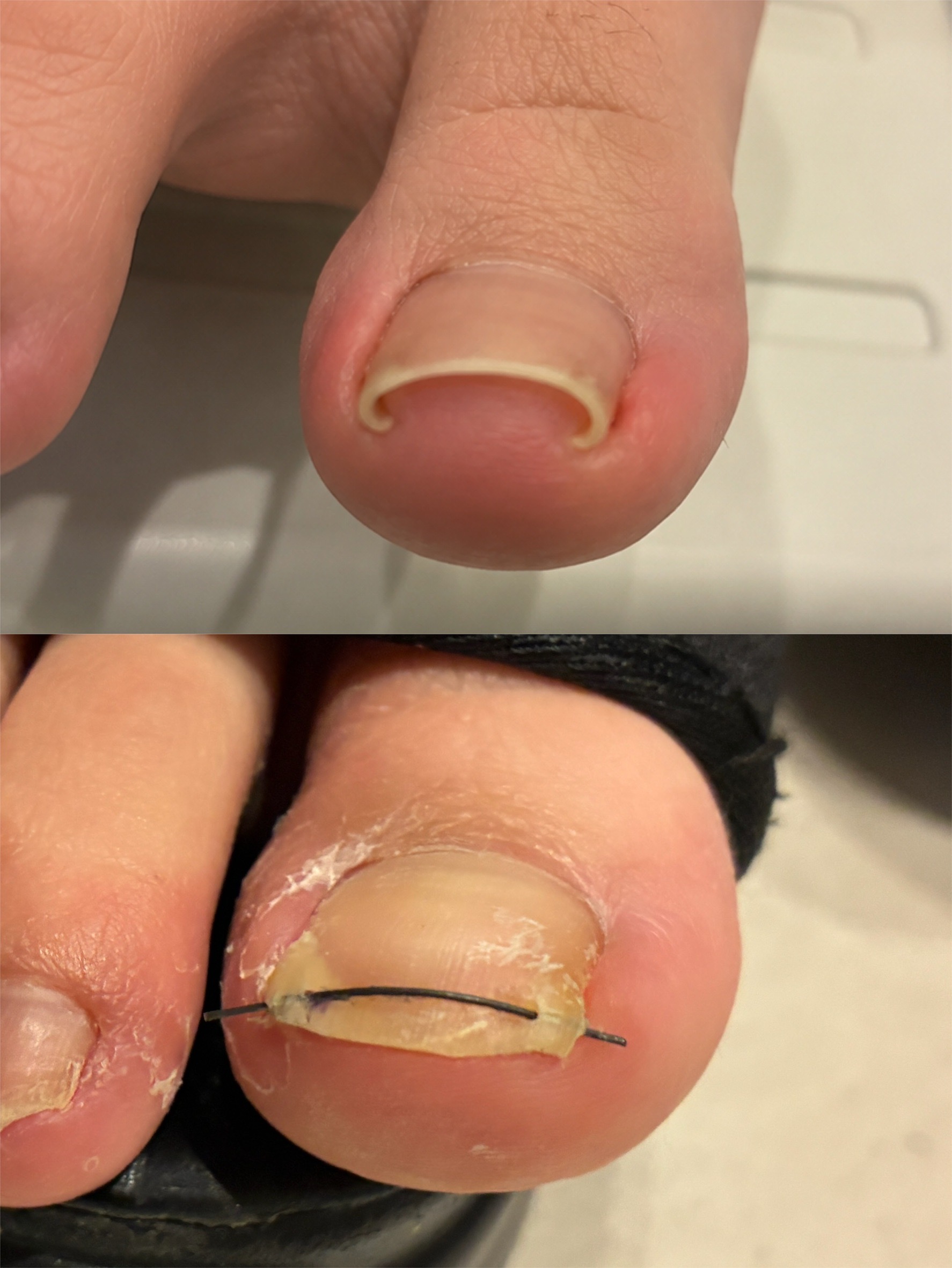ワイヤー法と40%尿素軟膏ODTによる巻き爪治療の症例写真。上が矯正前、下が10日後。