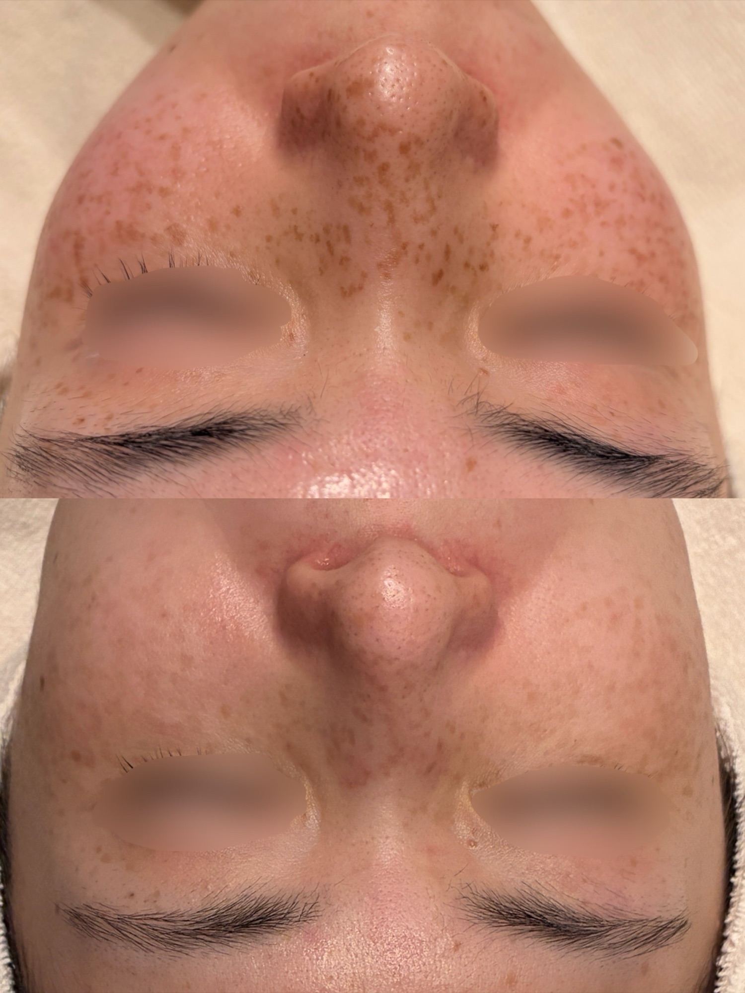 20代女性のルメッカ1回施術前後の正面症例写真。上がbefore、下がafter