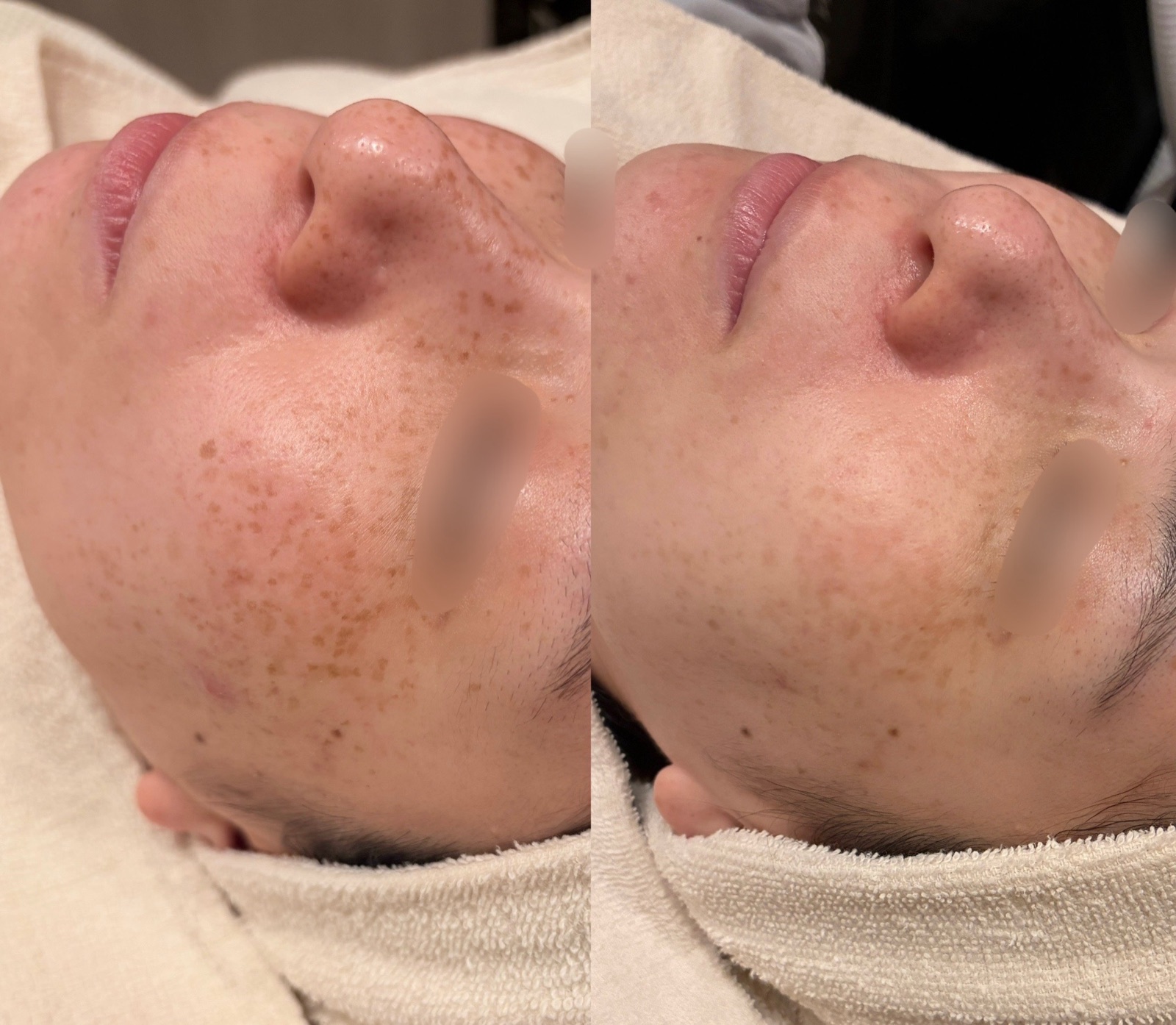 20代女性のルメッカ1回施術前後の斜めからの症例写真。左がbefore、右がafter