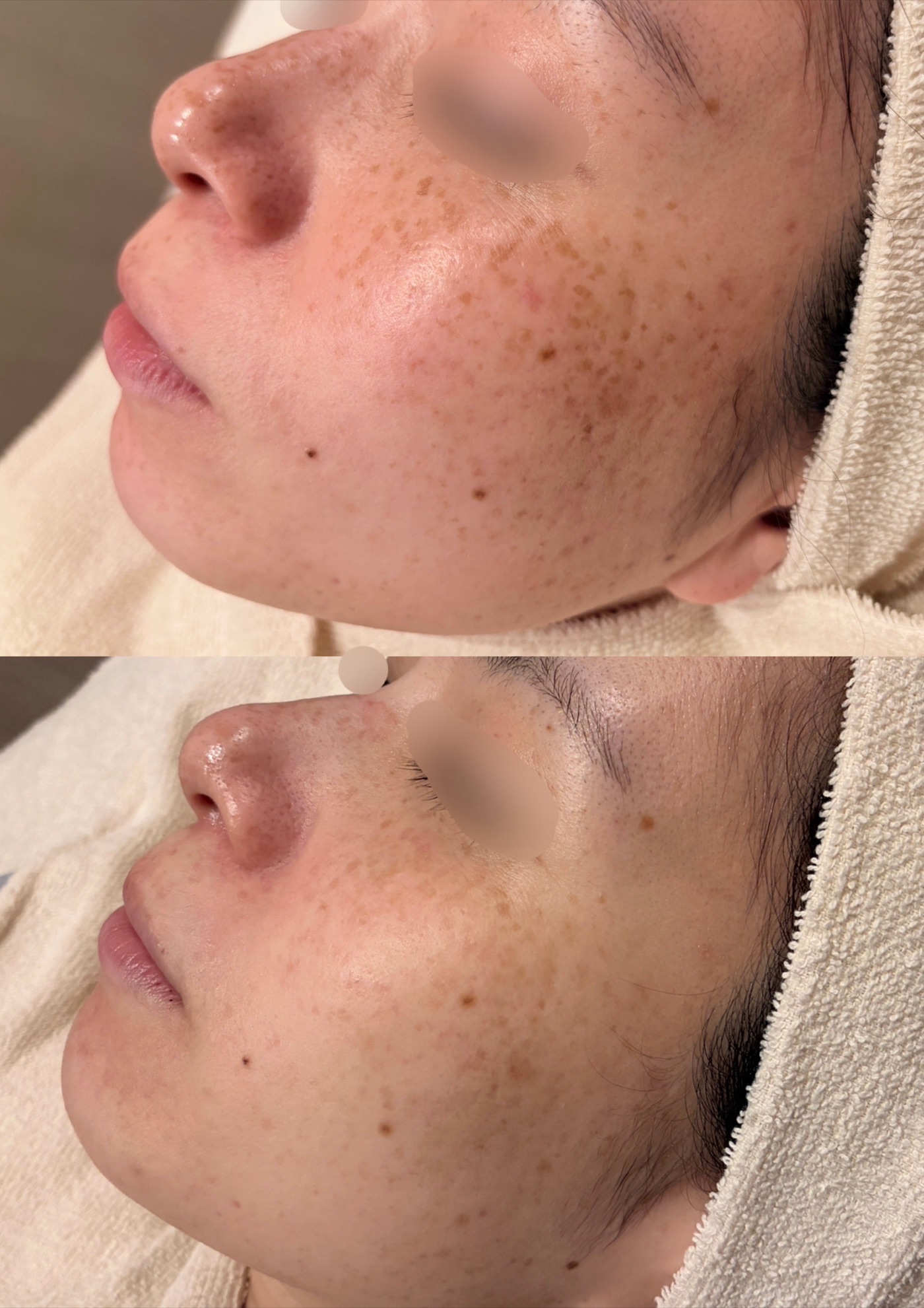 20代女性のルメッカ1回施術前後の側面症例写真。上がbefore、下がafter