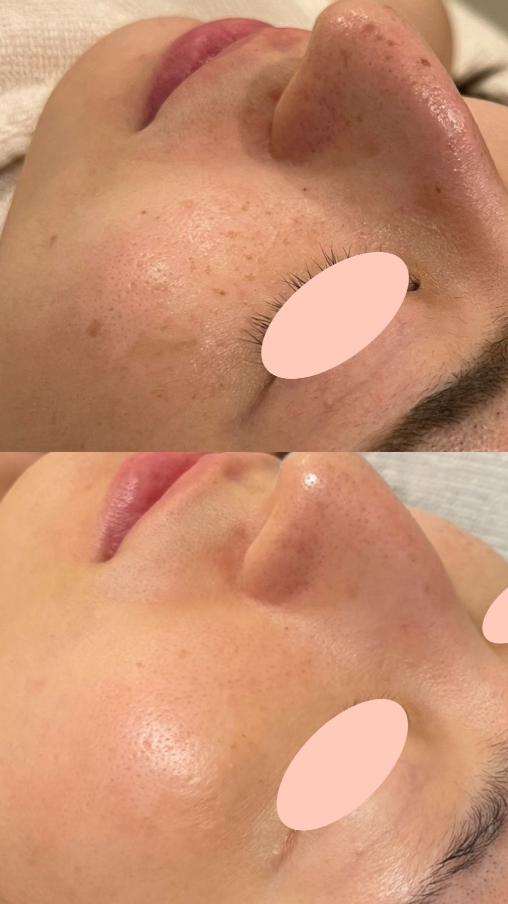 20代女性のハイドラジェントルとルメッカ1回施術前後の斜位症例写真。上がbefore、下がafter