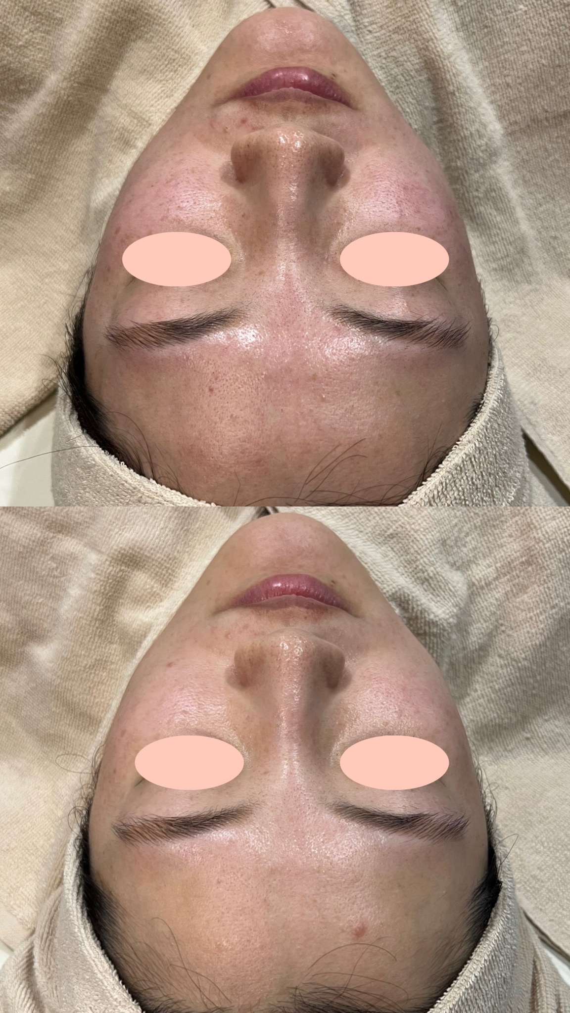 20代女性のハイドラジェントルとルメッカ1回による赤ら顔改善の正面症例写真。上がbefore、下がafter