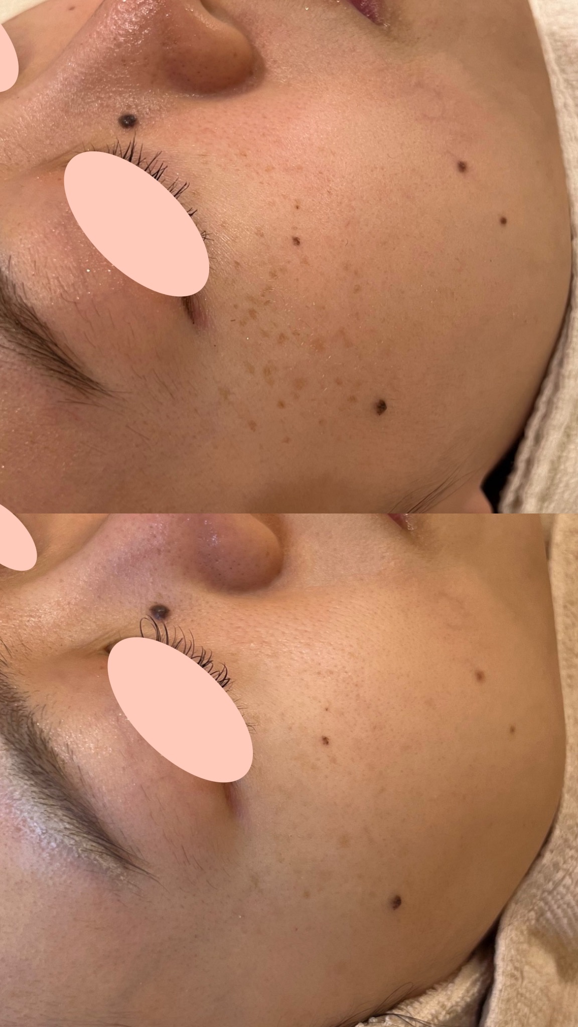 20代女性のルメッカ2回による赤ら顔とシミ改善の頬アップ症例写真。上がbefore、下がafter