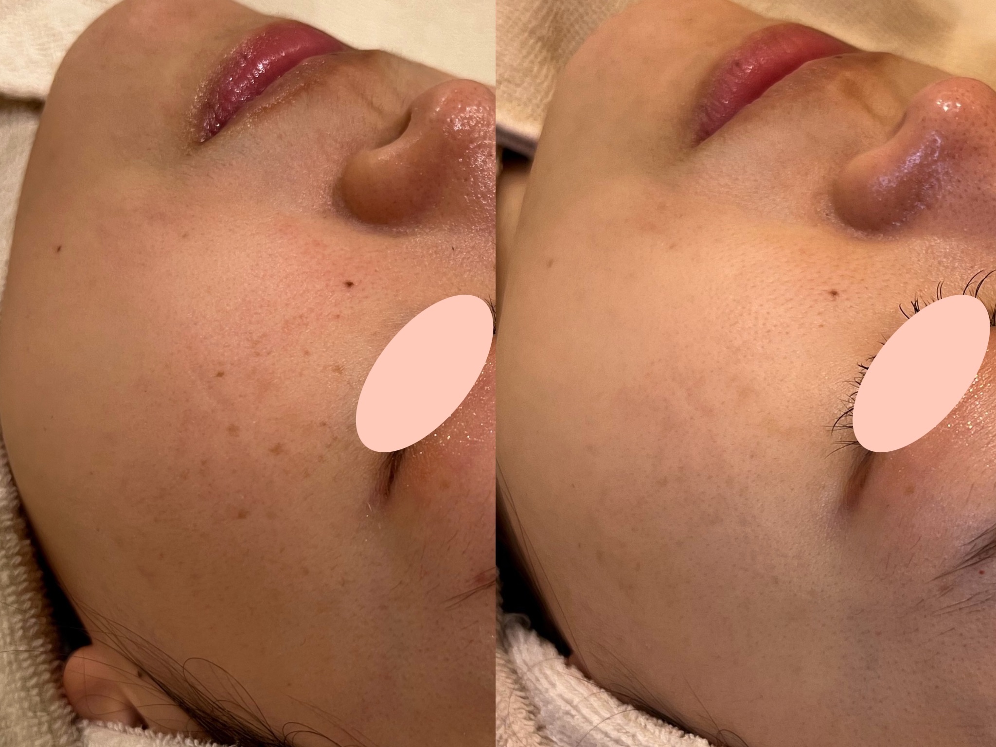 20代女性のルメッカ2回による赤ら顔とシミ改善の斜位症例写真。左がbefore、右がafter