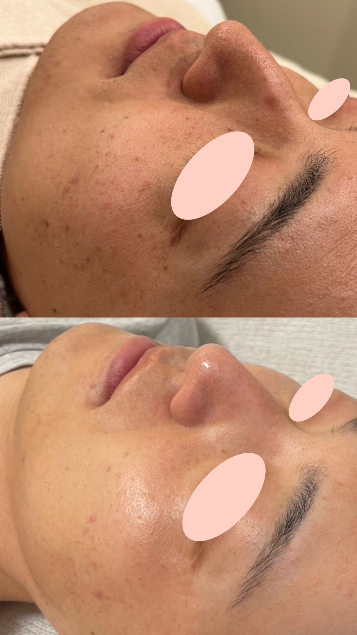 30代男性のハイドラジェントルとルメッカ1回施術前後の症例写真。上がbefore、下がafter