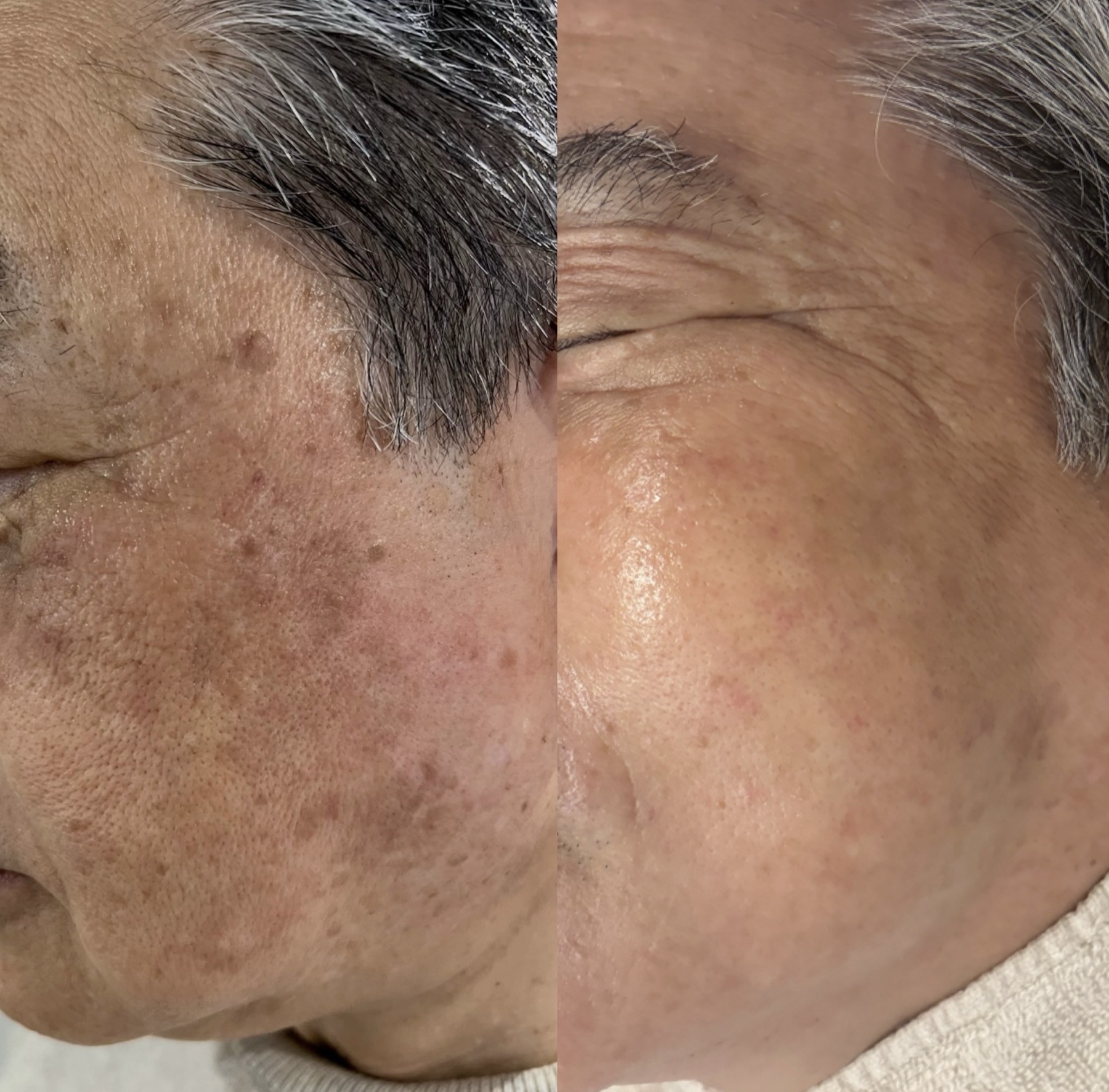 60代男性のルメッカ3回と脂漏性角化症に対するCO2レーザー1回施術前後の症例写真。左がbefore、右がafter