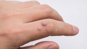 池袋で尋常性疣贅（いぼ）を皮膚科で相談｜魚の目との違い