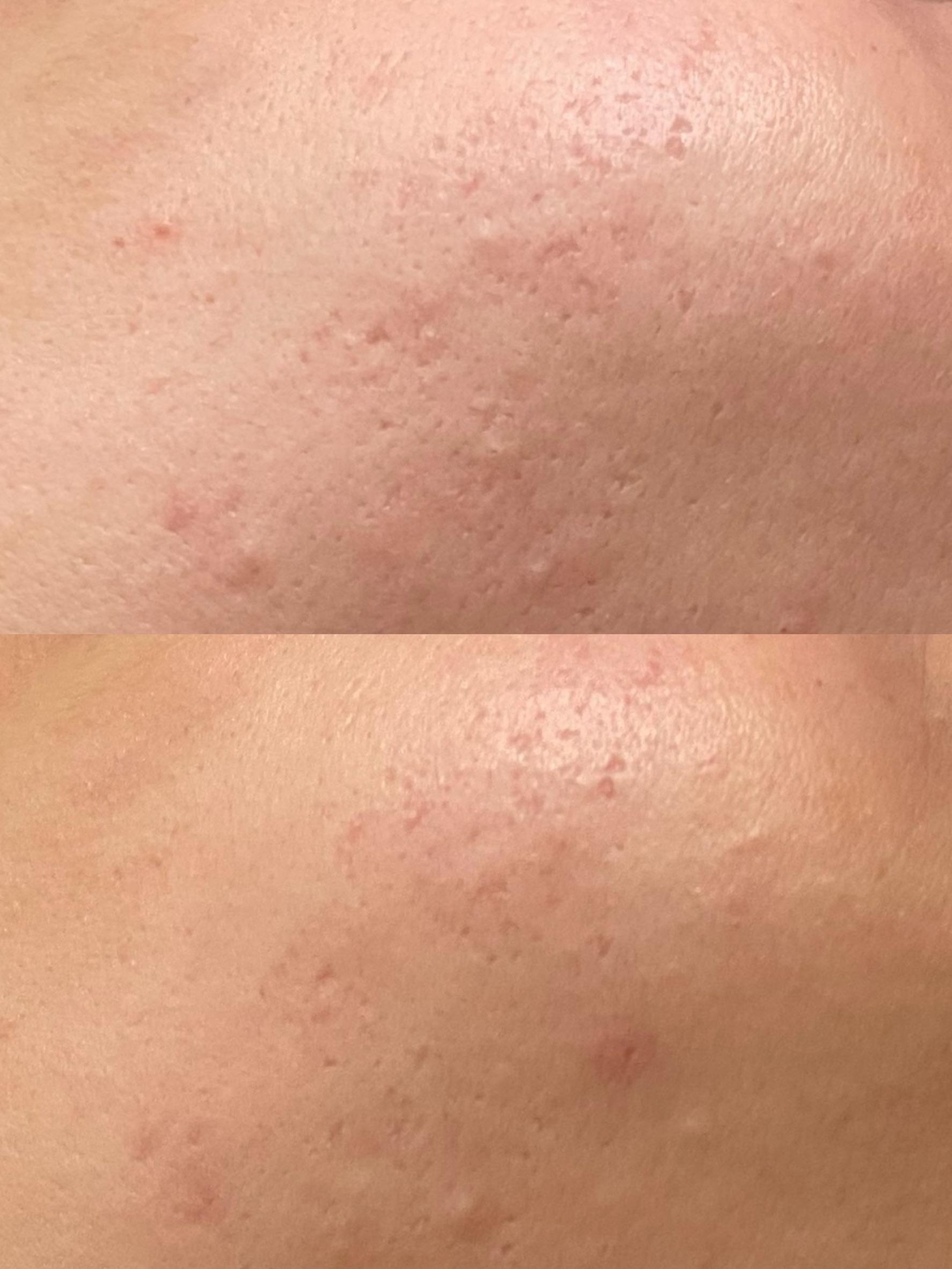 30代女性の頬のキュアジェット1回施術前後の症例写真。基本薬剤はジュベルック。上がbefore、下がafter