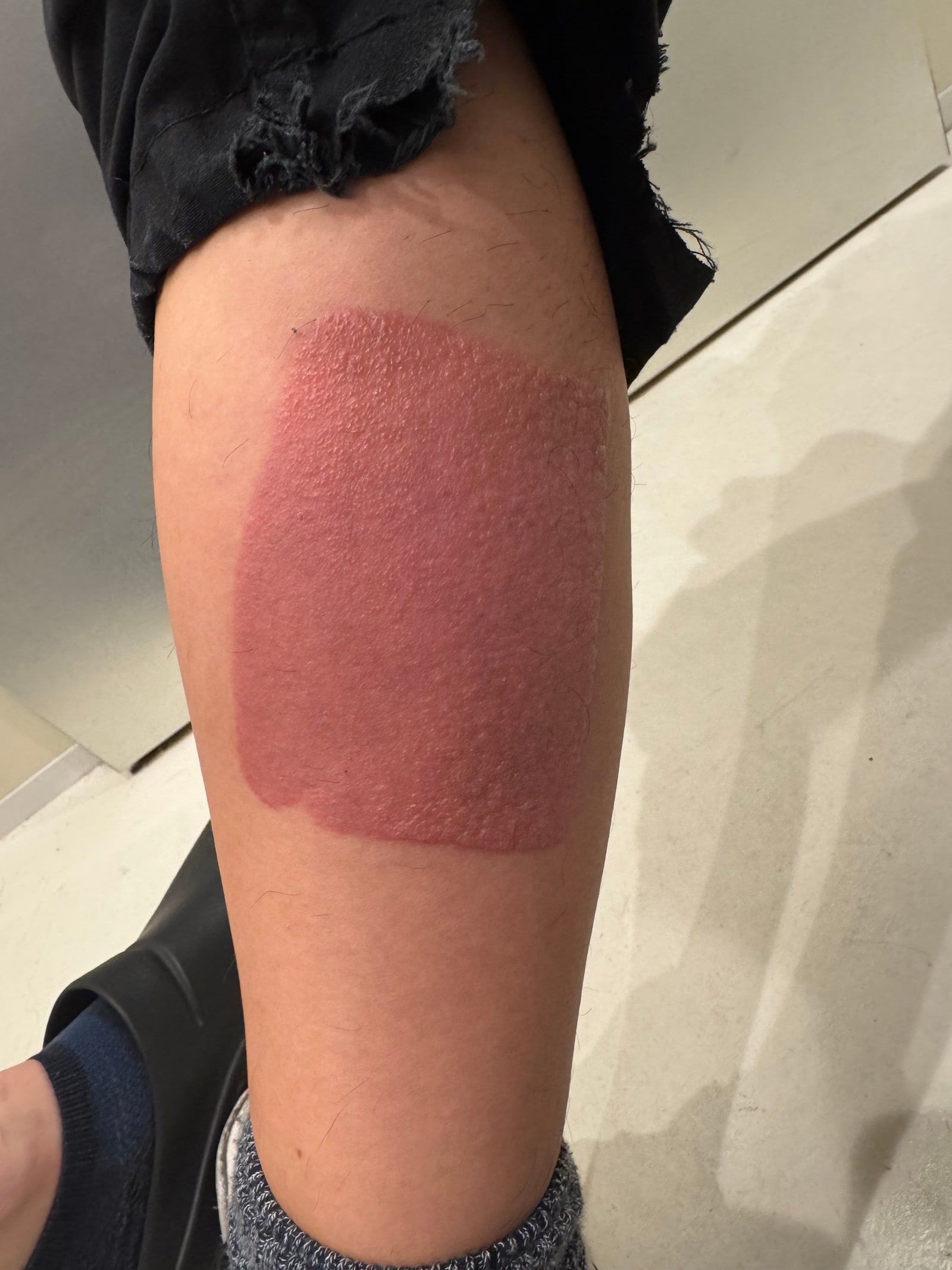 30代男性のふくらはぎにモーラステープの形に一致した境界明瞭な紅斑が見える光接触皮膚炎の症例写真