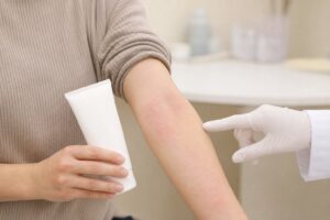 アトピーで日焼け止めがしみるとき｜見直す6項目と受診目安