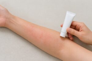 アトピーで塗り薬がしみるとき｜確認する5項目と相談目安