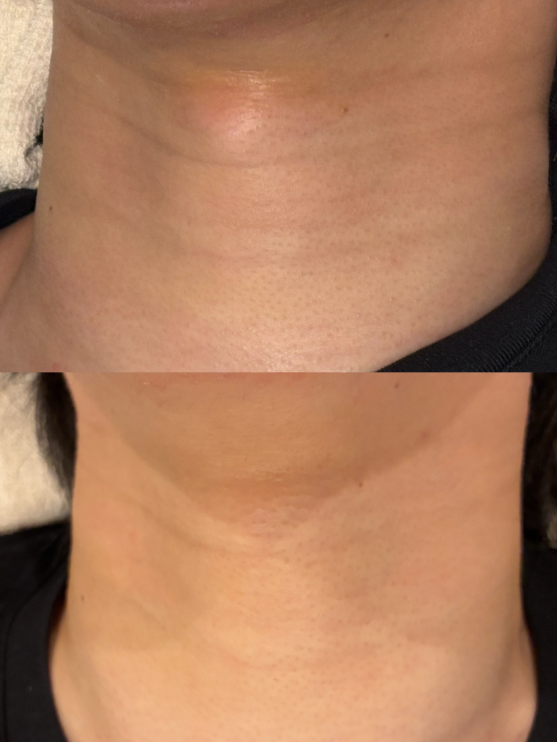 首のしわ2本にキュアジェットを2回施術し、追加薬剤レニスナを使用した症例写真。上が施術前、下が2回目施術1か月後