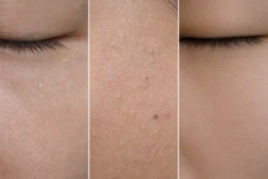 池袋の汗管腫治療｜目の下のブツブツ・CO2レーザーを皮膚科医が解説