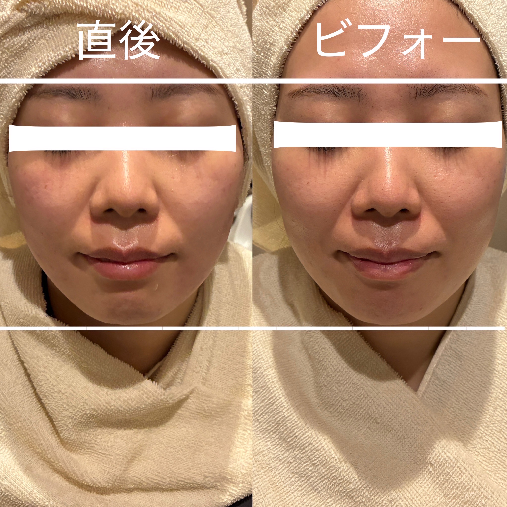 インモードVリフト（FORMA＋Fx）1回の症例写真。左は施術直後、右は施術前。